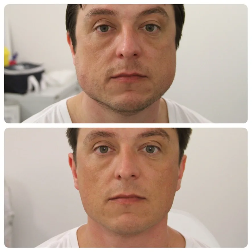 Male patient before and after two sessions of masseter Botox at CosmeDocs Harley Street — visibly reduced jaw width and softer lower-face contour