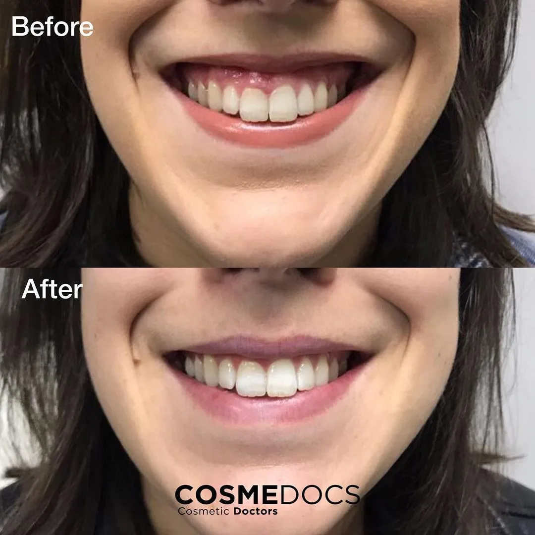 Before and after lip filler showing subtle enhancement with natural lip movement preserved during smiling