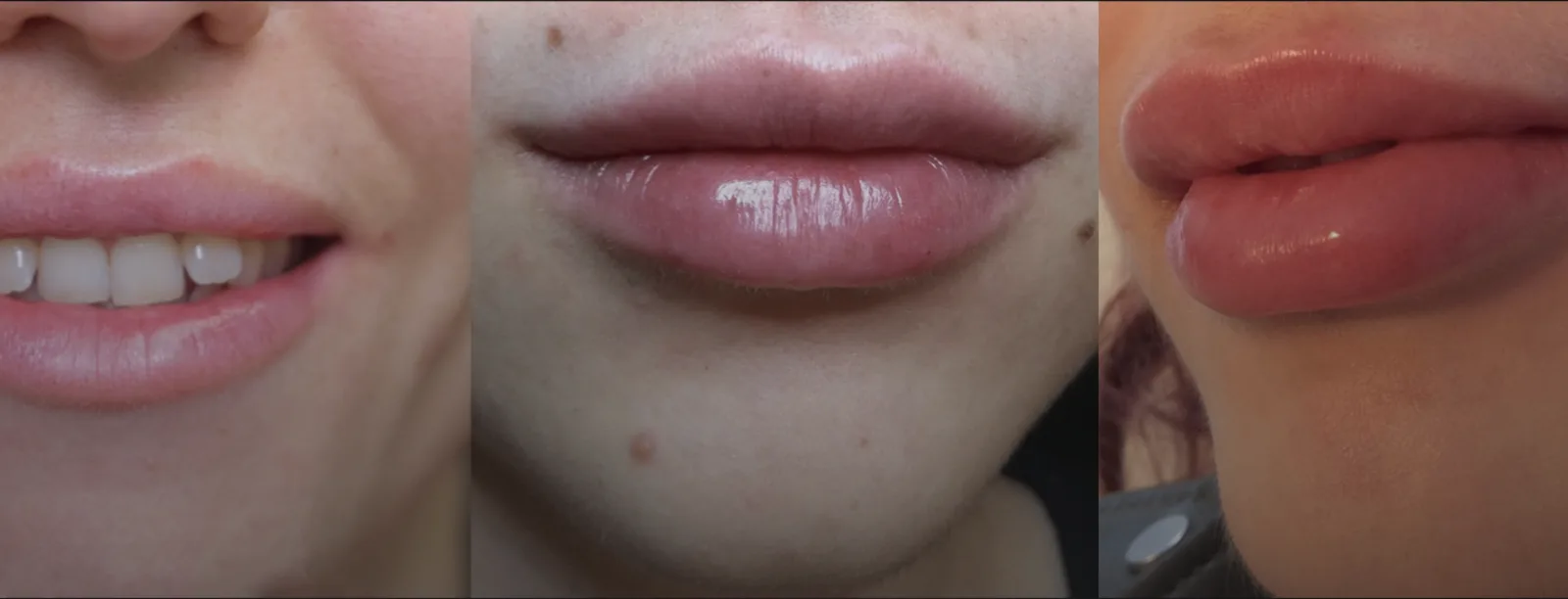 Three stages of lip filler showing natural lip, subtly enhanced lip with border definition, and full enhancement preserving natural shape