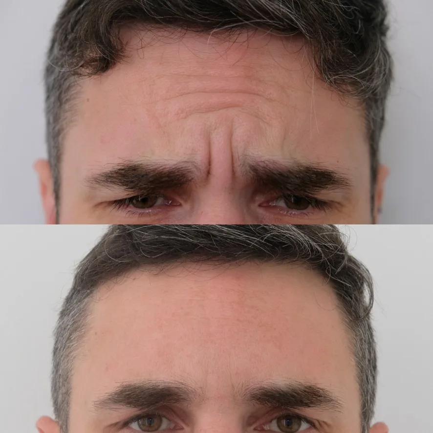 BroTox before and after, Cosmedocs
