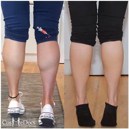 Calf Slimming before and after, Cosmedocs