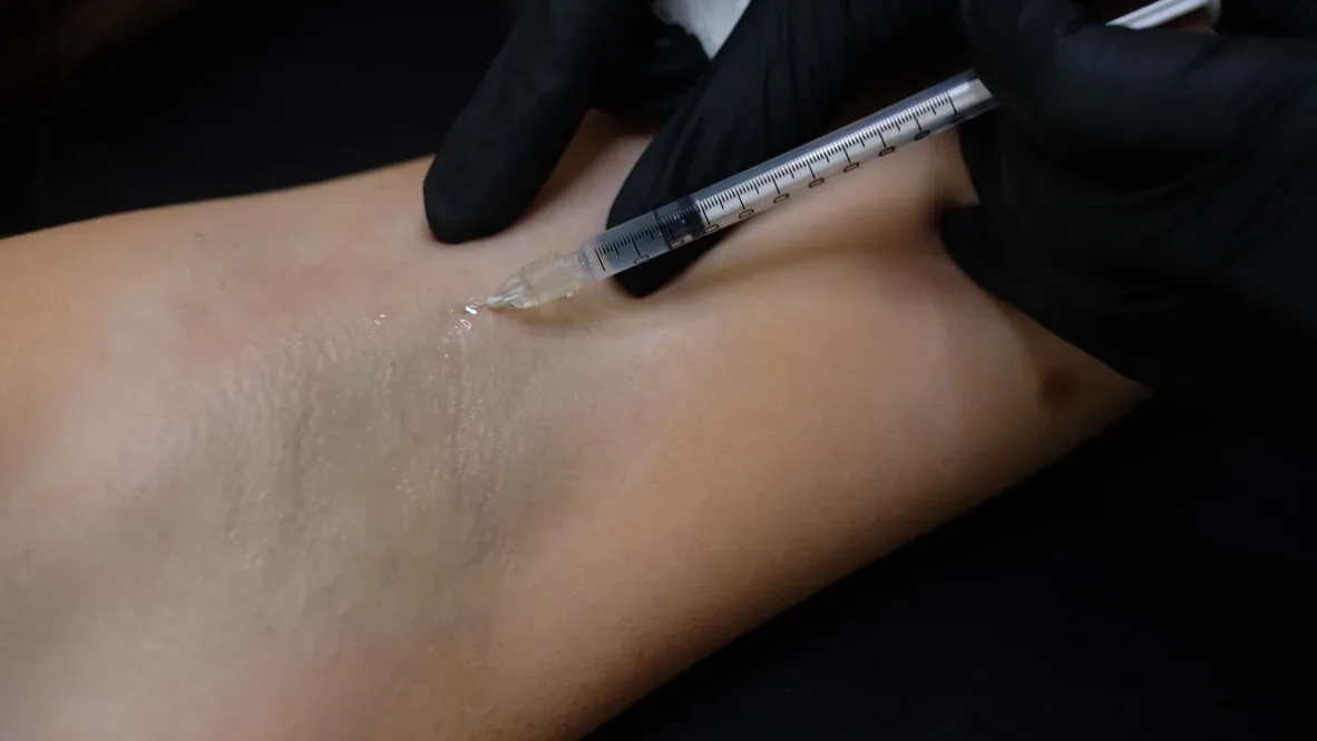 Hyperhidrosis before and after, Cosmedocs