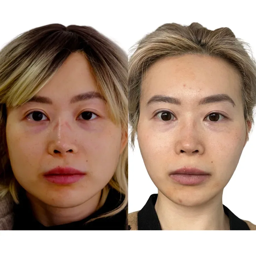 Masseter Botox before and after, Cosmedocs