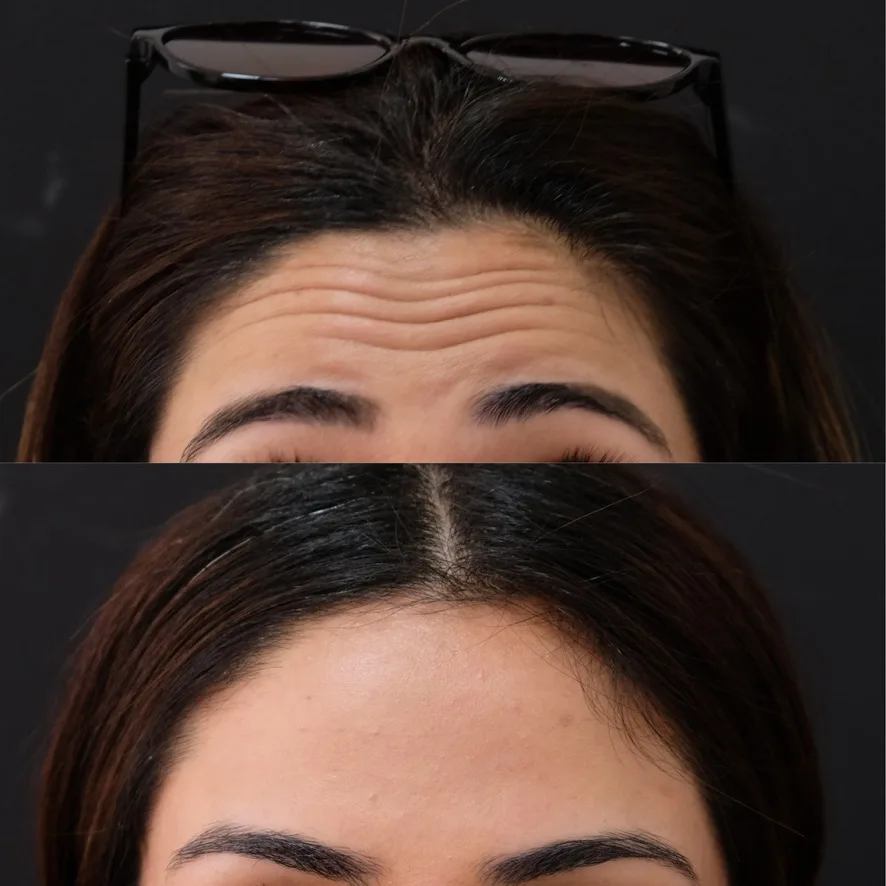 Forehead creases before and after Cosmedocs anti-wrinkle treatment