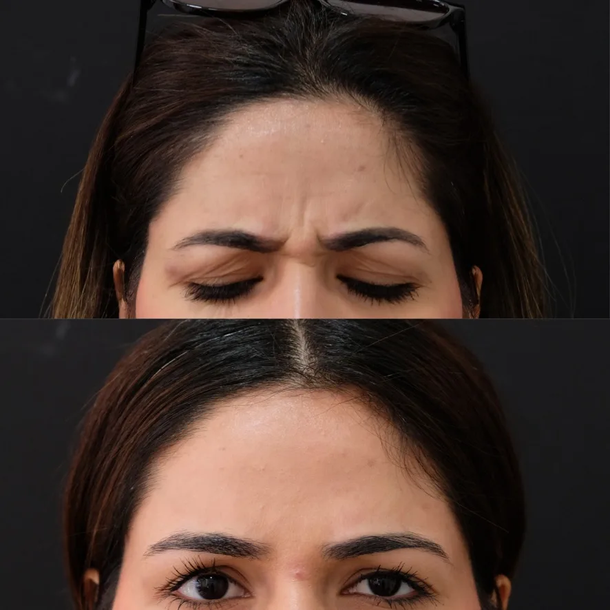 Glabellar frown lines before and after Cosmedocs anti-wrinkle treatment