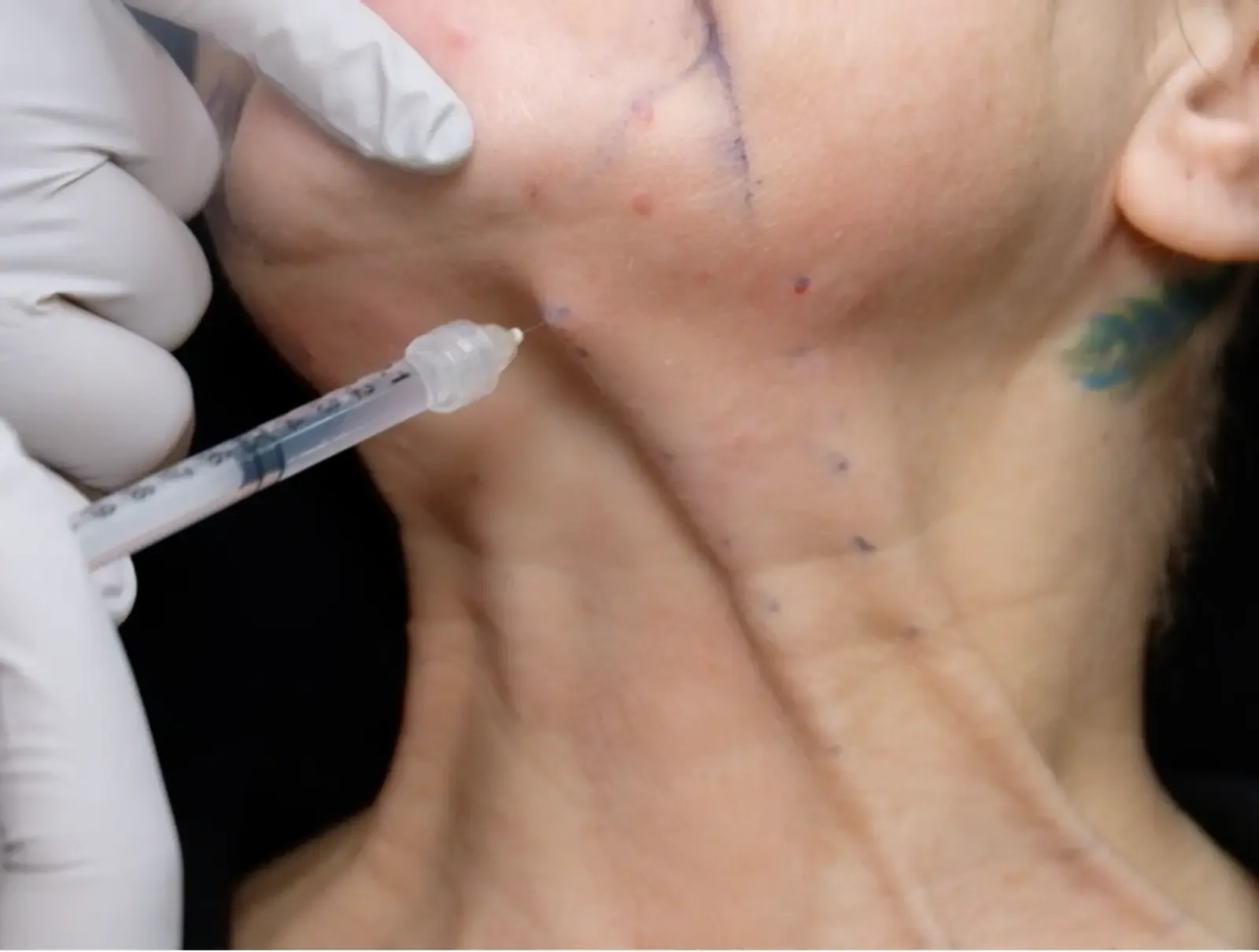 Side view of a doctor treating the platysma muscle at the neck