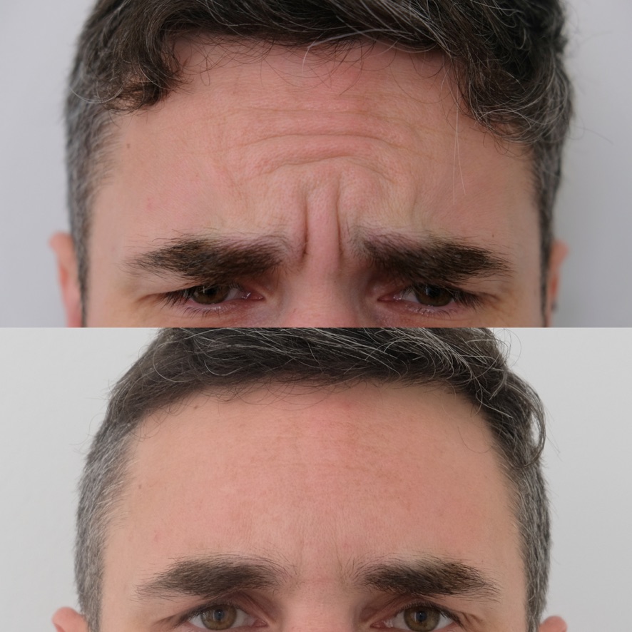 BroTox before and after, Cosmedocs