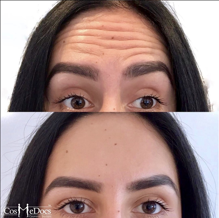 Forehead lines smoothed, before and after, Cosmedocs