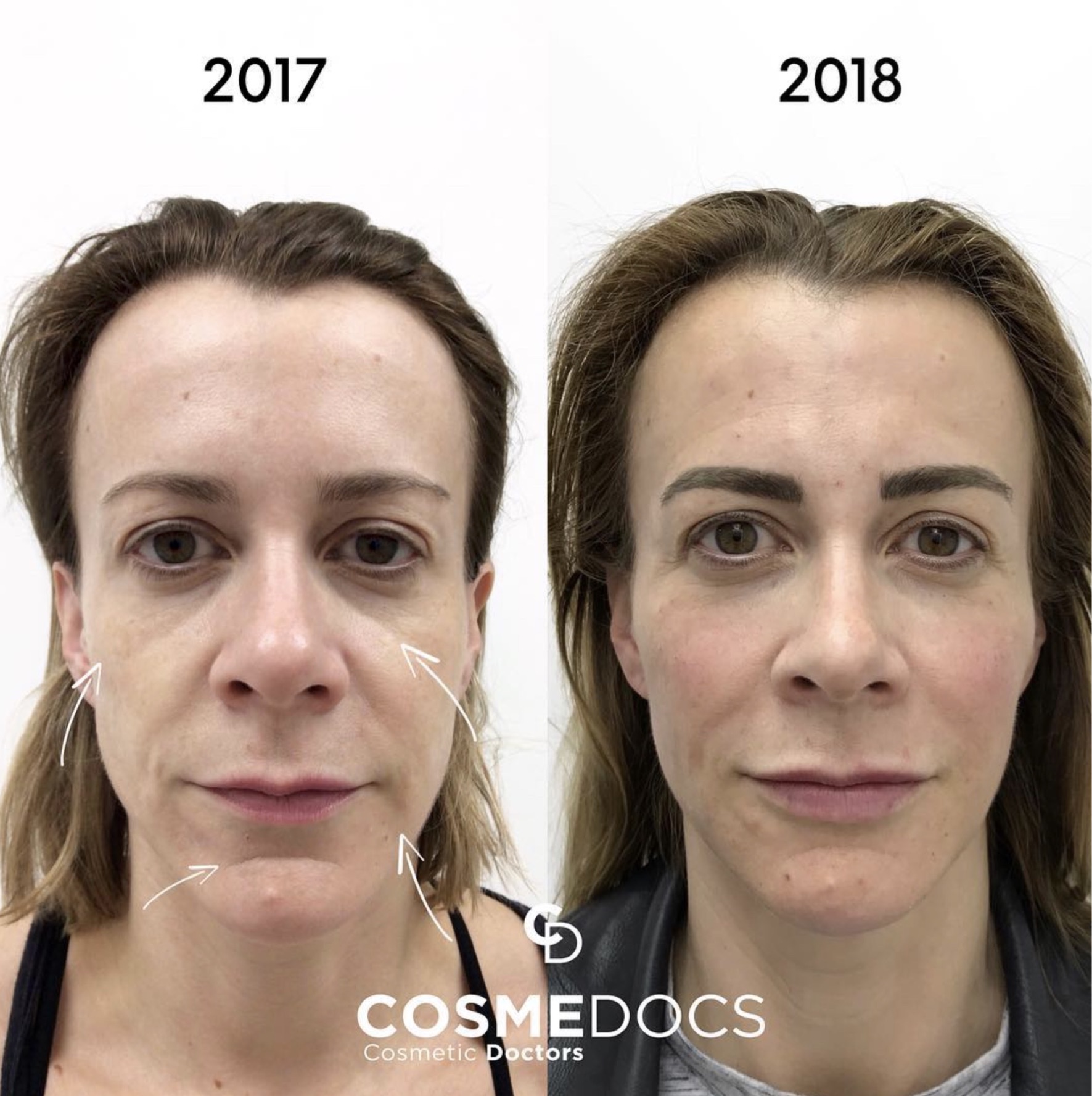 Cheek Filler before and after, Cosmedocs