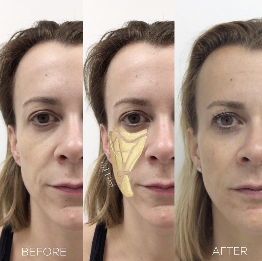 HA Makeover before and after, Cosmedocs