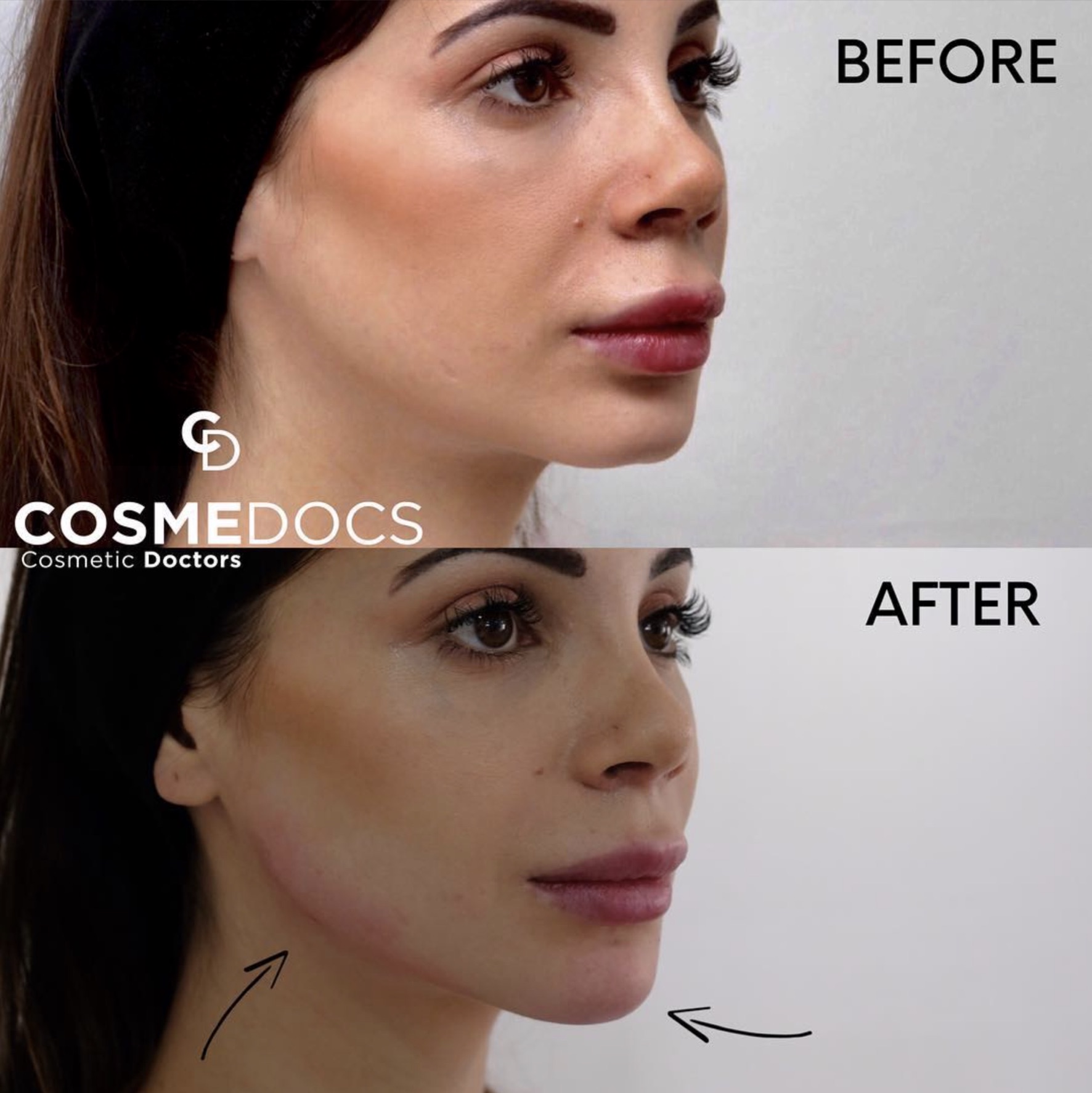 Jawline Definition before and after, Cosmedocs