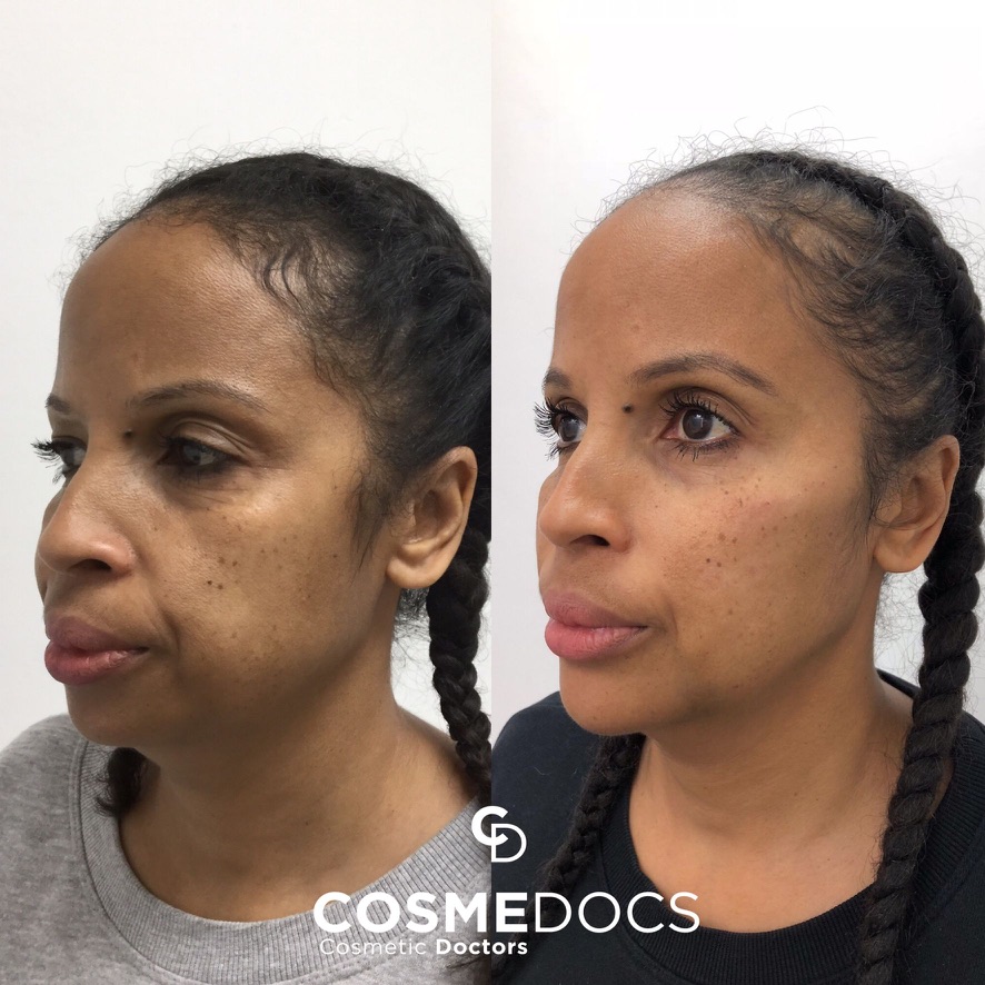 Jowl & Jawline before and after, Cosmedocs