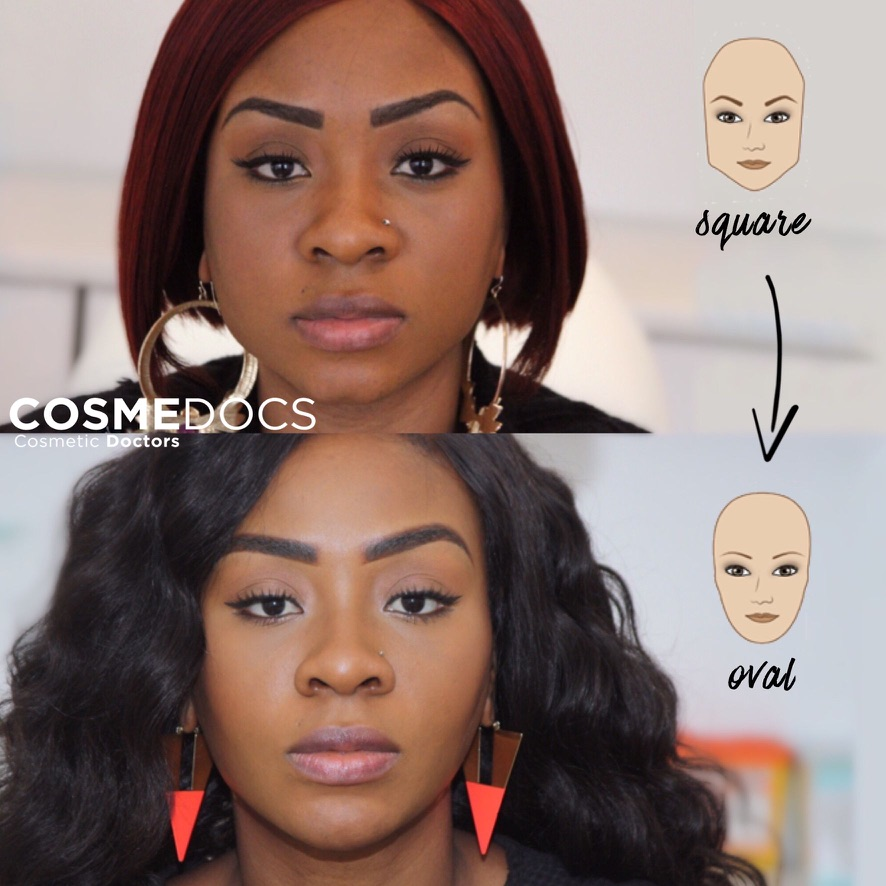 Masseter Botox before and after, Cosmedocs