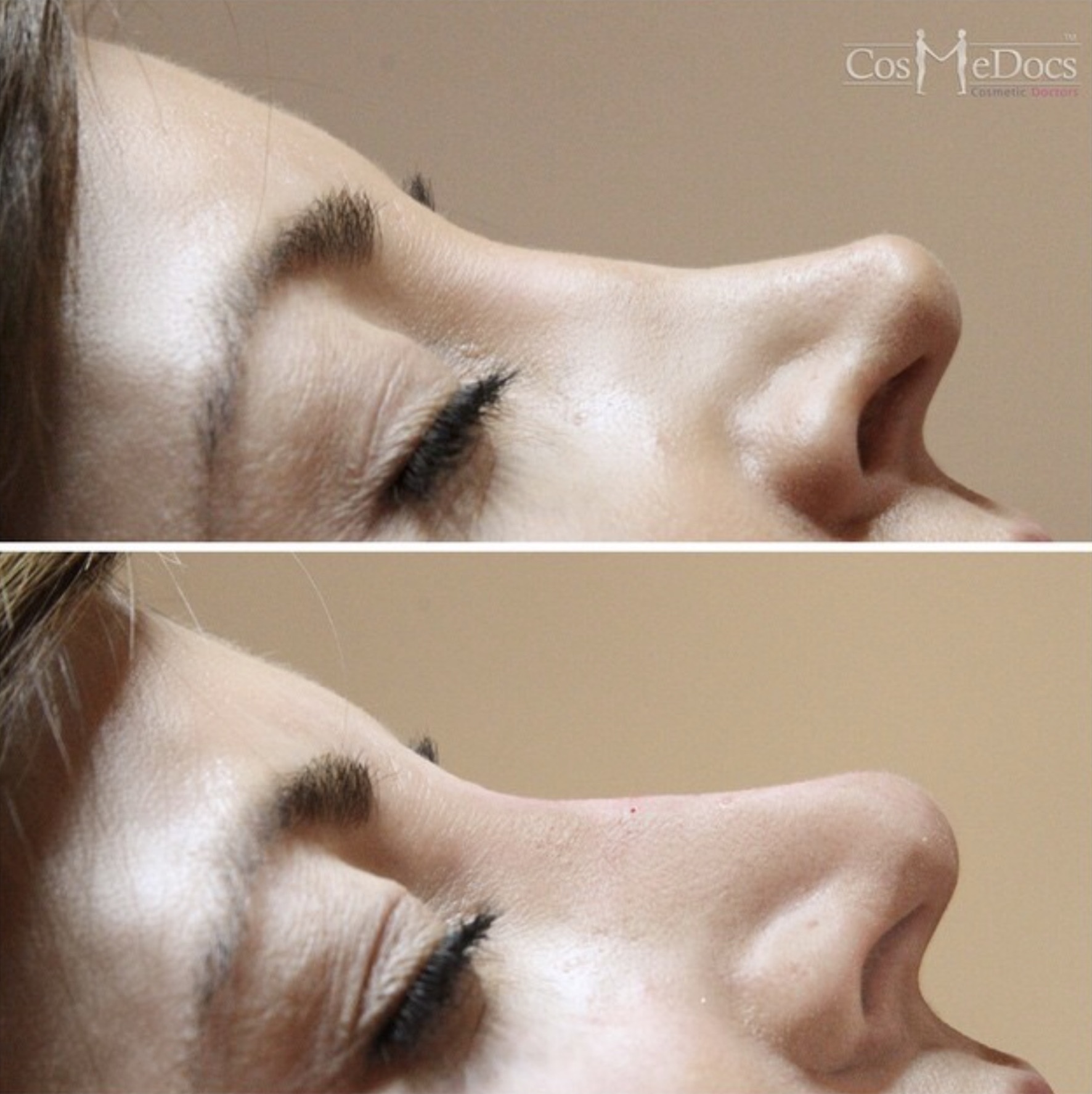 Non-Surgical Nose before and after, Cosmedocs