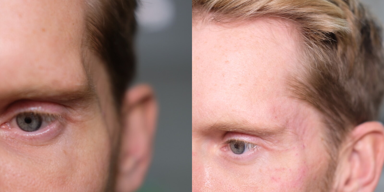 Temple Filler before and after, Cosmedocs