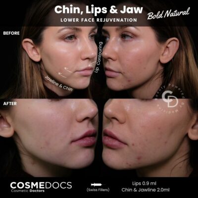Before and after jawline filler showing lower face rejuvenation and enhanced jaw contour