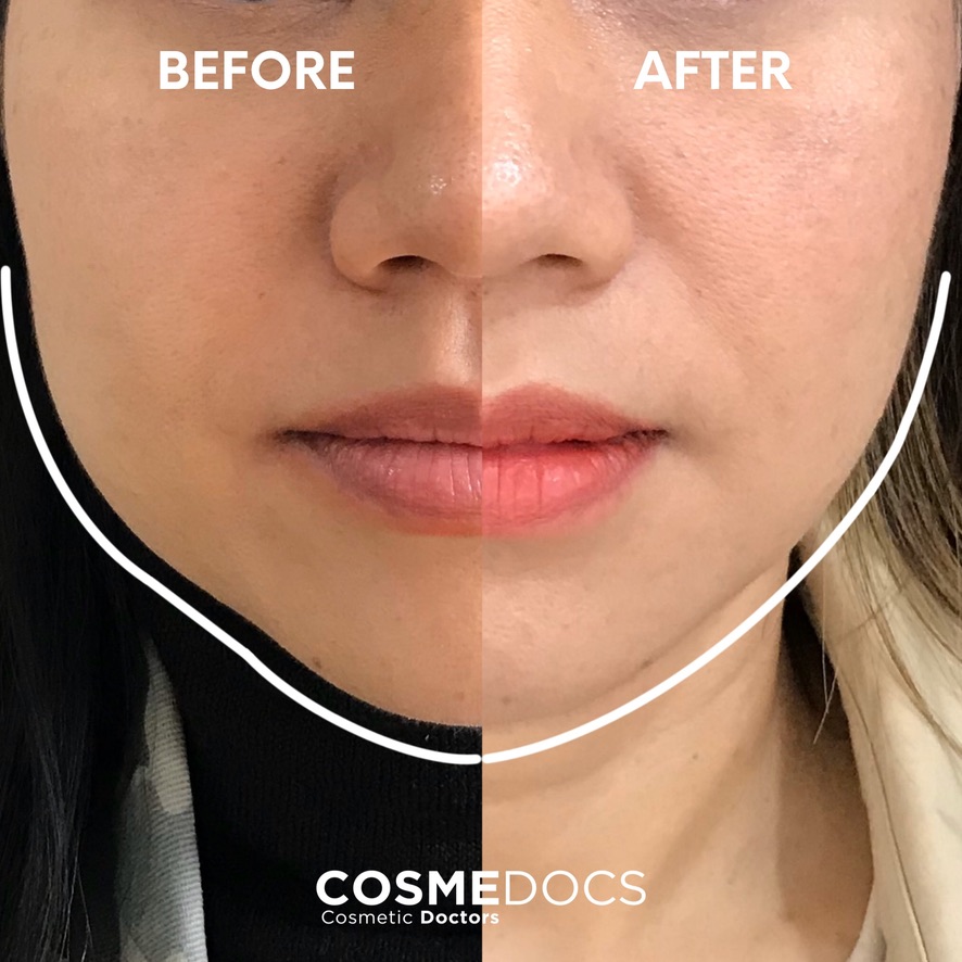 Masseter Botox before and after, Cosmedocs