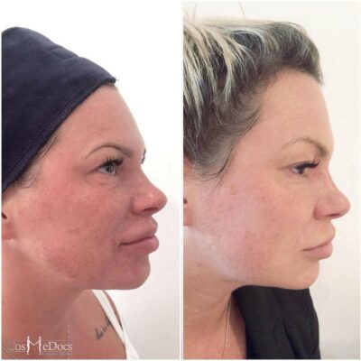 PDO Threads before and after, Cosmedocs