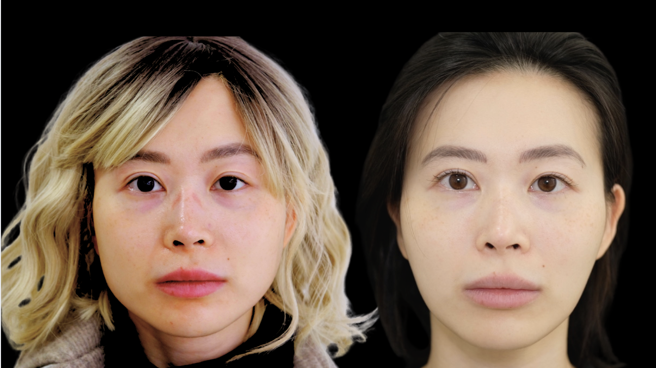 Before and after masseter Botox showing reduced jaw muscle bulk