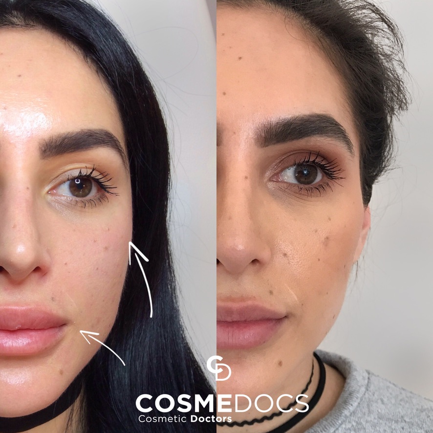 Cheek filler contouring