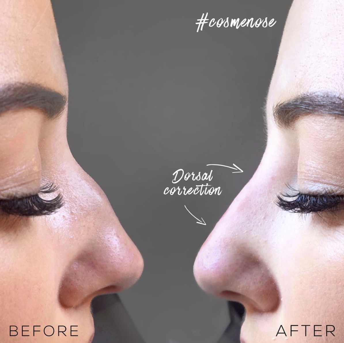 Non-surgical nose job results